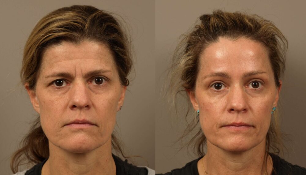 Brow Lift for a Youthful, Refreshed Appearance