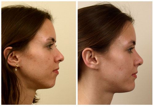 Get a Chin Implant for Improved Facial Contours