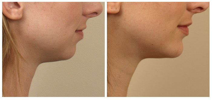 Chin Implant for a Sculpted, Natural Appearance