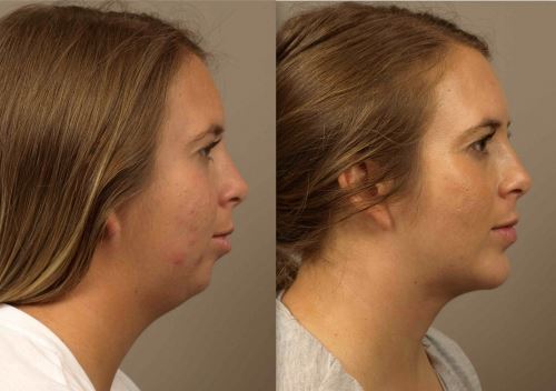 Get a Chin Implant for Improved Facial Contours