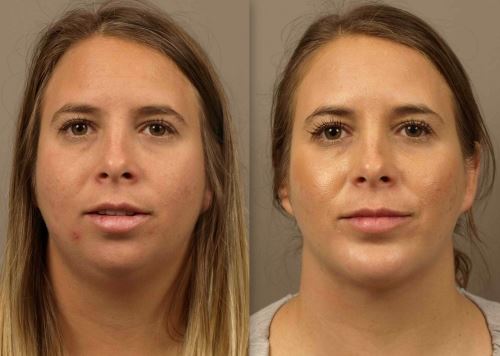 Chin Implant for a Balanced, Defined Profile