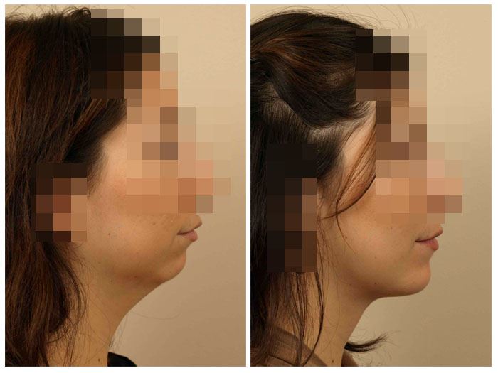 Improve Facial Symmetry with Chin Implant Surgery
