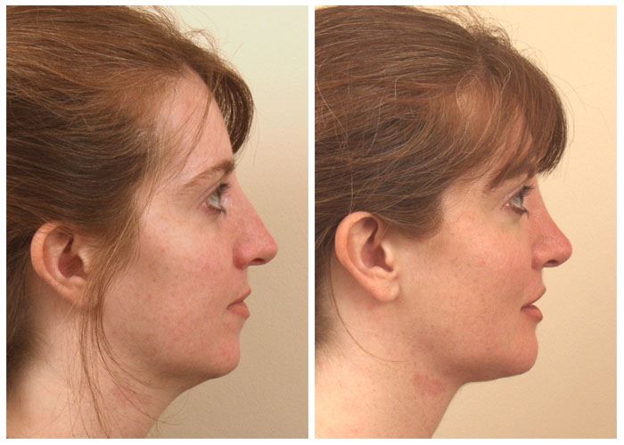 Chin Implant Surgery for a Defined, Stronger Jawline
