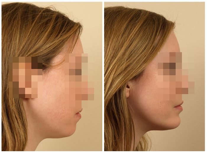 Chin Implant for a Balanced, Defined Profile