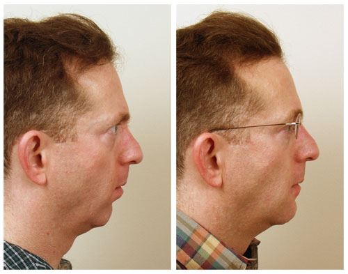 Chin Implant for a More Defined Facial Profile