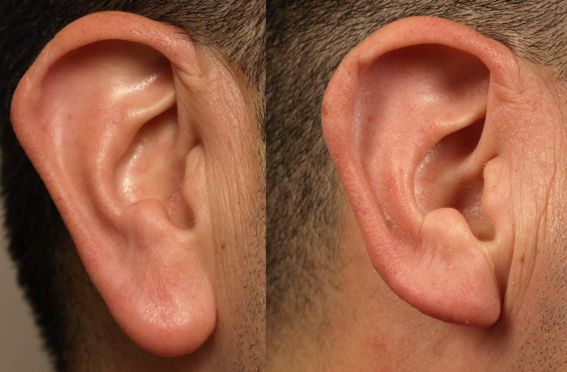 Earlobe Shortened for a Natural, Balanced Look