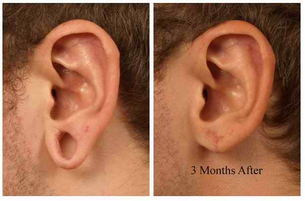 Earlobe Shortening for a Proportional Appearance