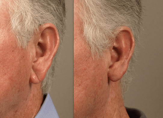 Get Your Earlobe Shortened for Symmetry
