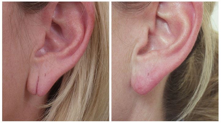 Shorten Earlobes for a Refined, Natural Look