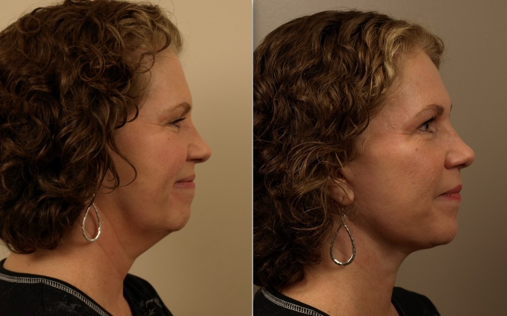 Facelift Surgery for a Youthful, Refreshed Appearance