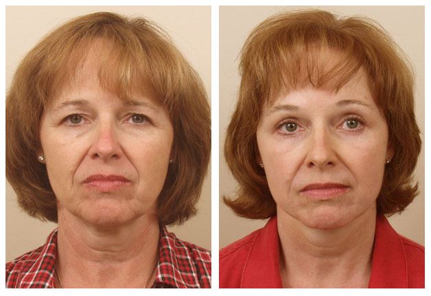 Facelift, Browlift, Eyelid Surgery & Laser Resurfacing Around the Mouth