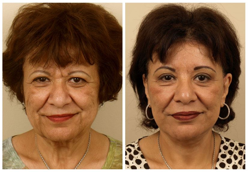 Facelift Surgery for Natural, Long-Lasting Results