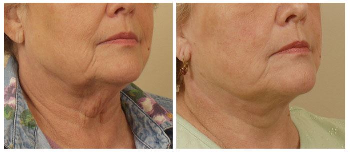 Facelift Surgery for a Younger, Revitalized Face