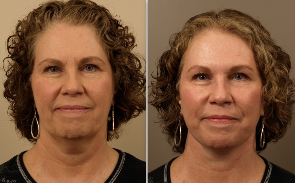 Restore Your Youth with Facelift Surgery