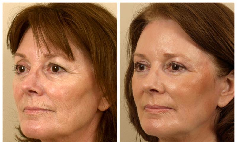 Laser Skin Resurfacing for Younger-Looking Skin