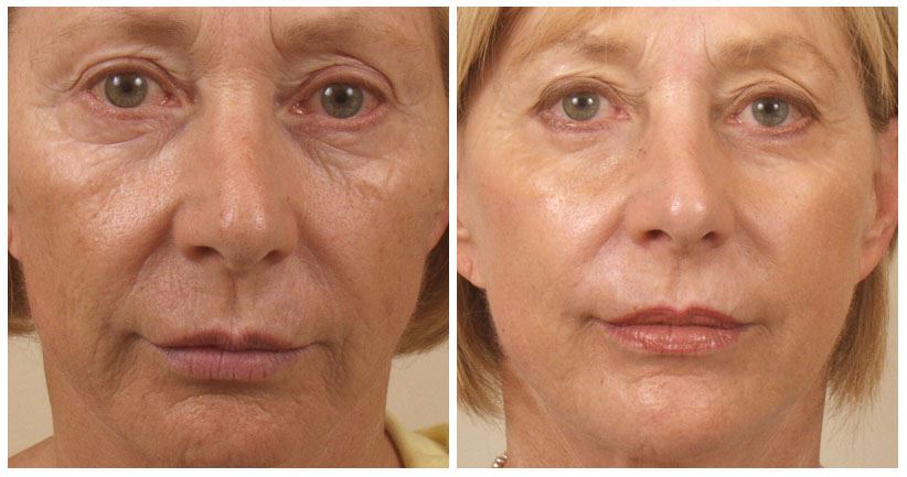 Revitalize Your Skin with Laser Skin Resurfacing