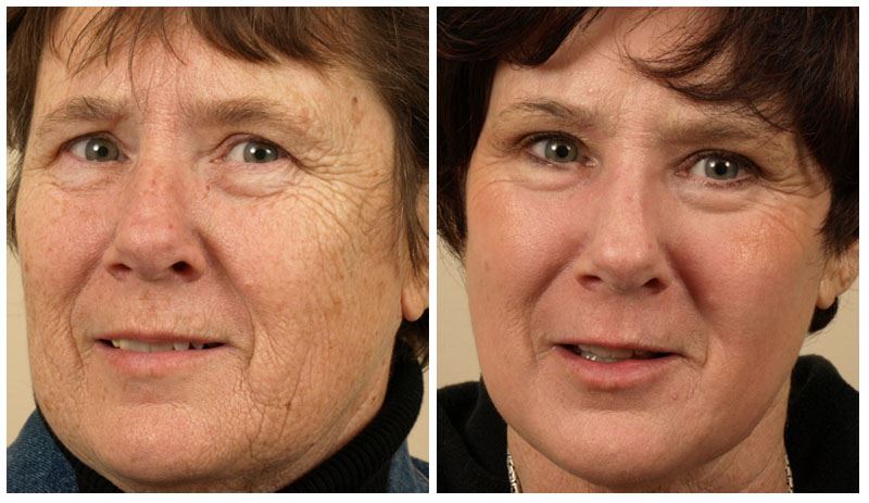 Restore Your Skin with Laser Skin Resurfacing