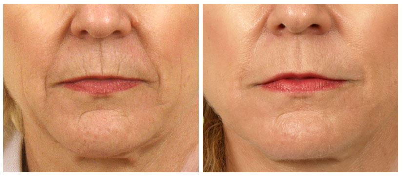 Laser Skin Resurfacing for Youthful Glow