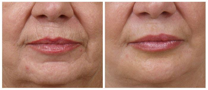Get Laser Skin Resurfacing for Youthful Skin