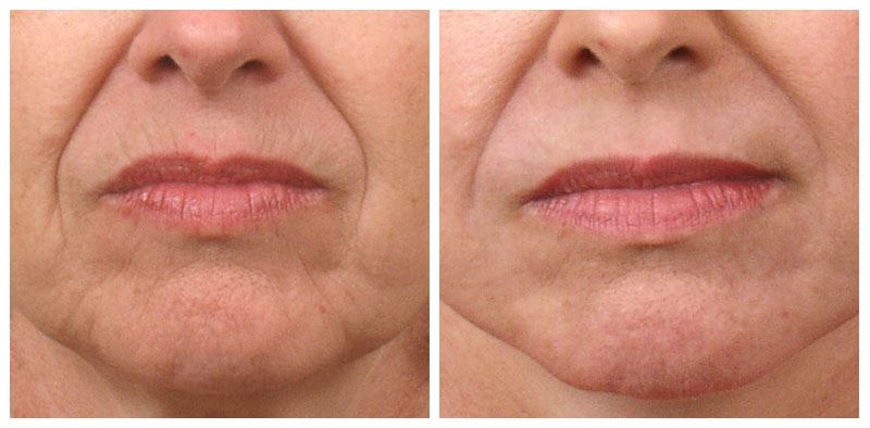 Laser Skin Resurfacing to Reduce Wrinkles and Scars