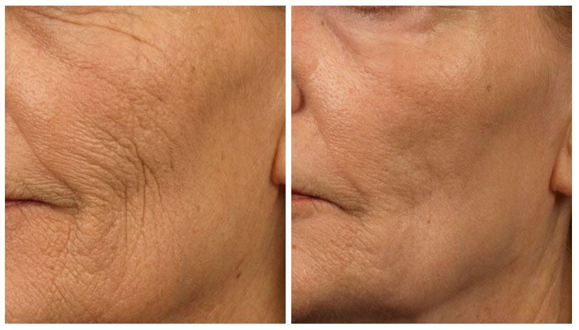 Laser Skin Resurfacing for Smoother Skin Texture
