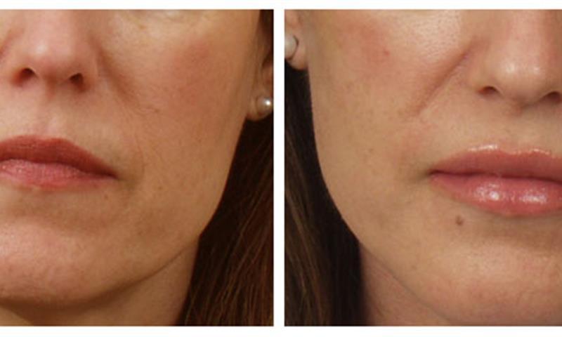 Get Natural Fullness with Lip Augmentation