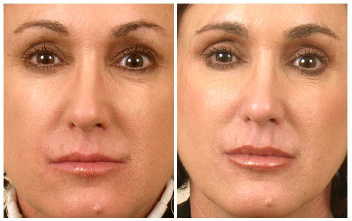 Enhance Your Smile with Lip Augmentation