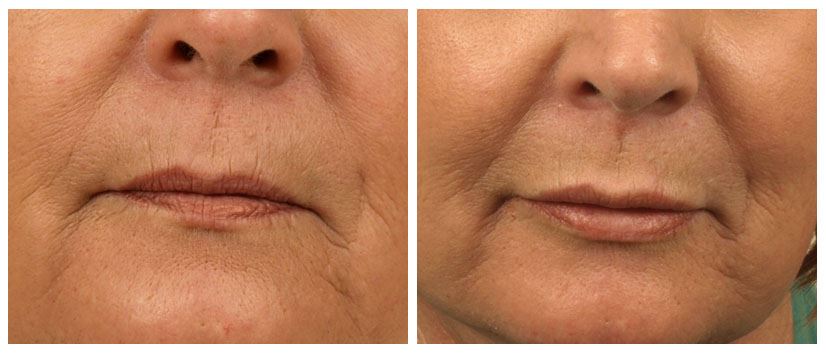 Lip Augmentation for Fuller, Natural Lips