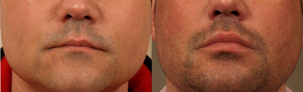 Lip Augmentation for Plumper, Defined Lips