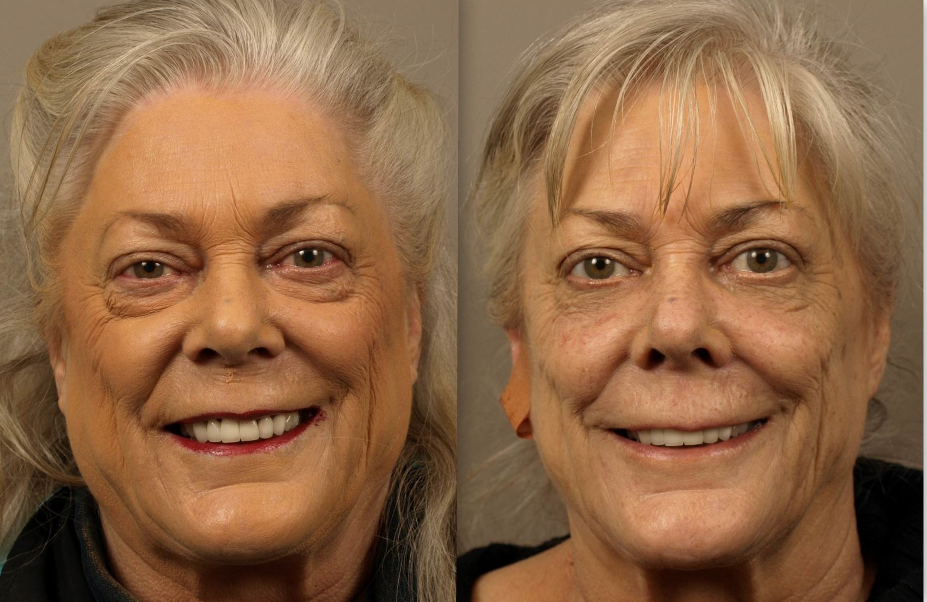 Brighten Your Eyes with Lower Blepharoplasty