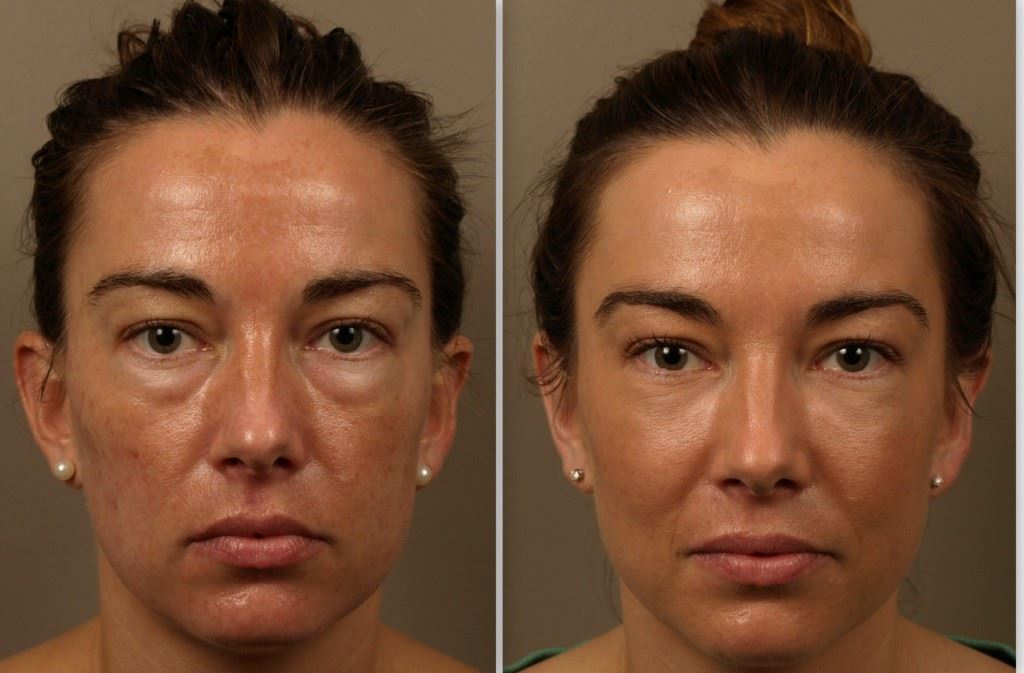 Lower Blepharoplasty for Tired, Puffy Eyes