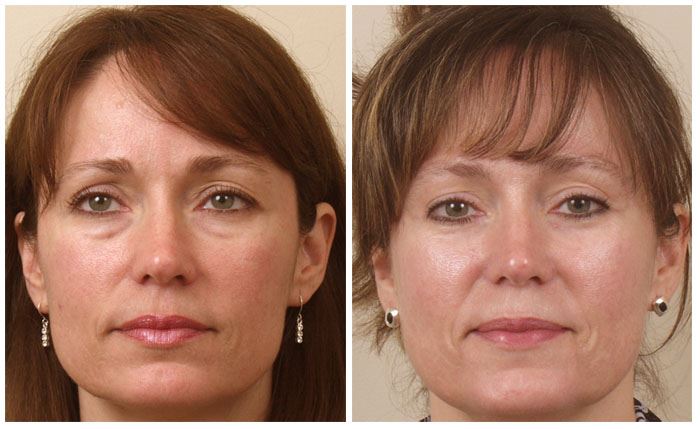 Lower Blepharoplasty for a Youthful Eye Area
