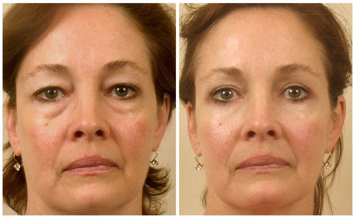 Lower Blepharoplasty to Reduce Under-Eye Bags