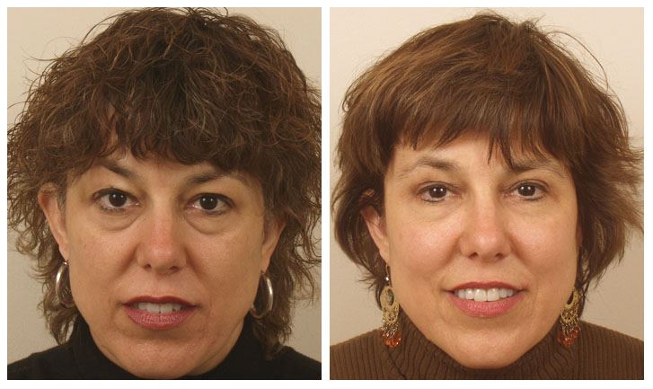 Get Lower Blepharoplasty for Youthful Under-Eyes