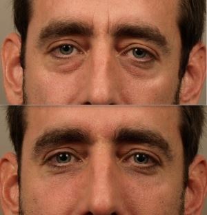Lower Blepharoplasty for Brighter, Youthful Eyes