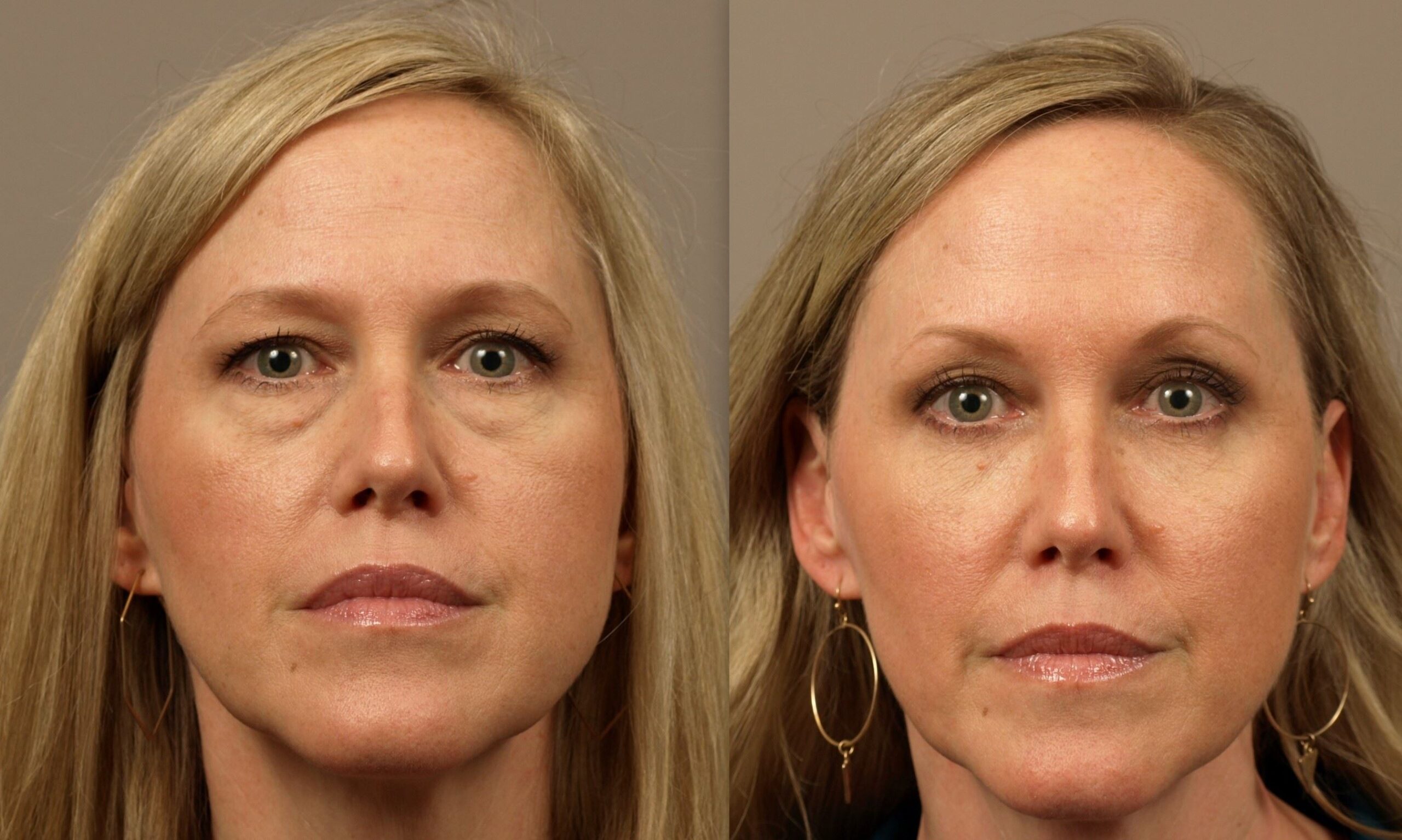 Lower Blepharoplasty for Youthful, Bright Eyes