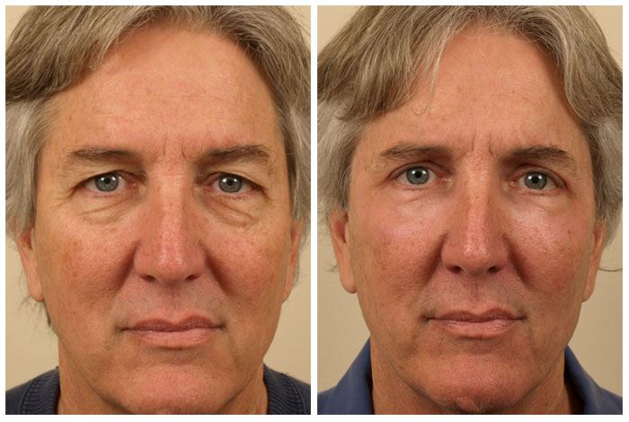 Tear Trough Implants for a Youthful Under-Eye Look