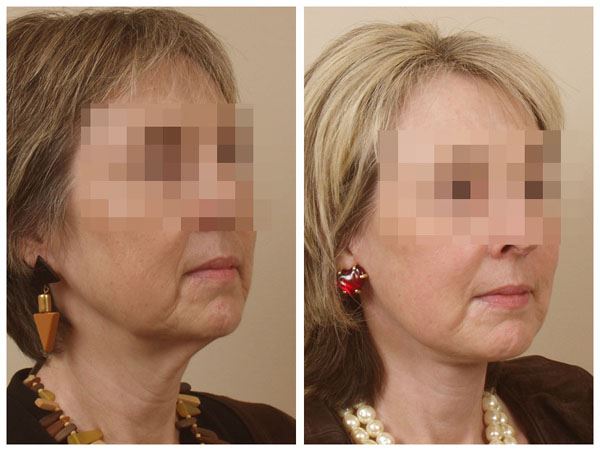 Achieve a Youthful Look with Facelift Surgery