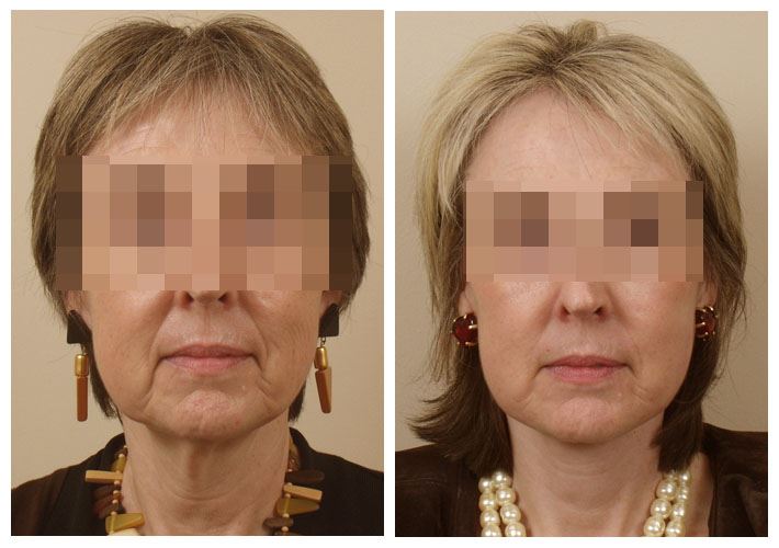 Facelift Surgery to Reduce Wrinkles and Lift Skin