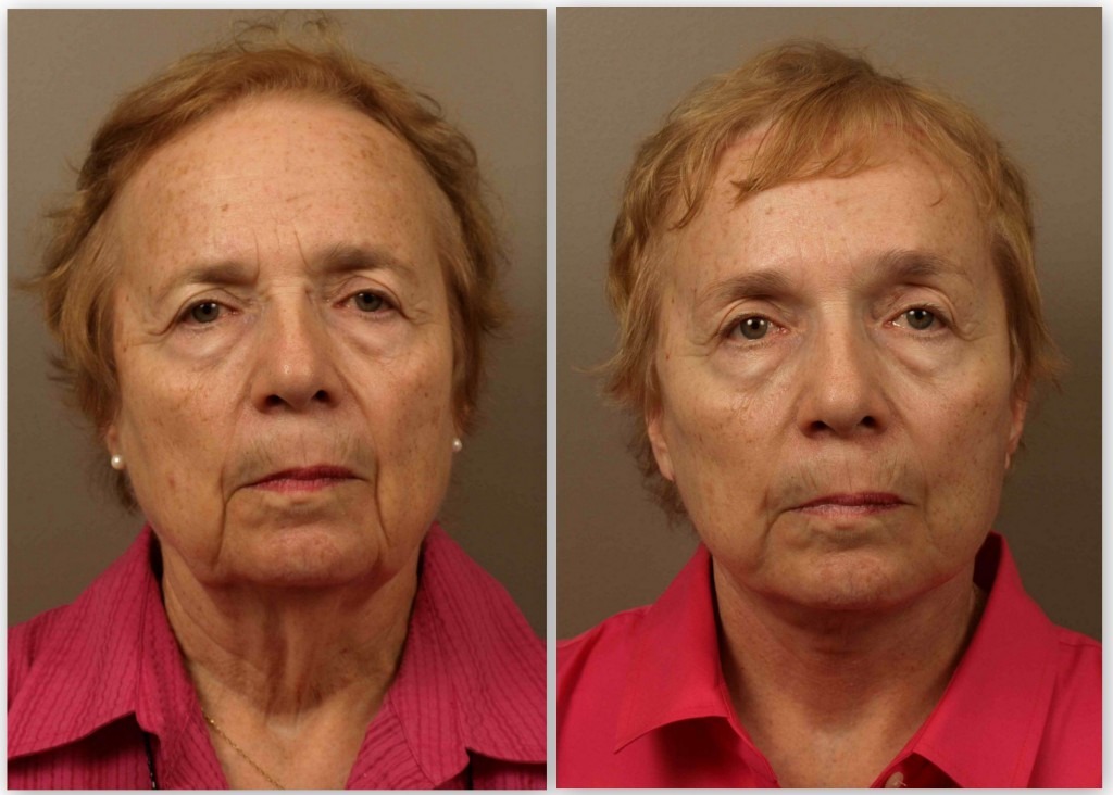 Total Facial Rejuvenation: Facelift, Browlift, Eyelid Surgery