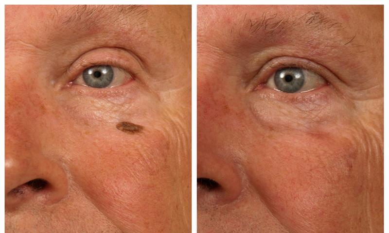 Mole Lesion Removal for Clear, Healthy Skin
