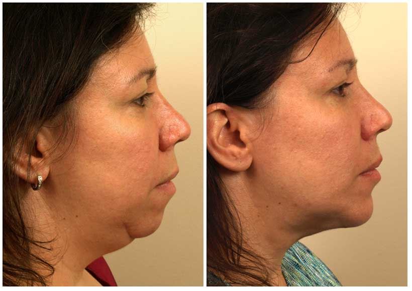 Chin Implant for Enhanced Jawline and Facial Balance