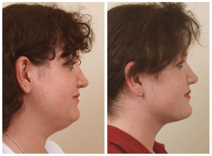 Get a Youthful Neckline with Neck Liposuction