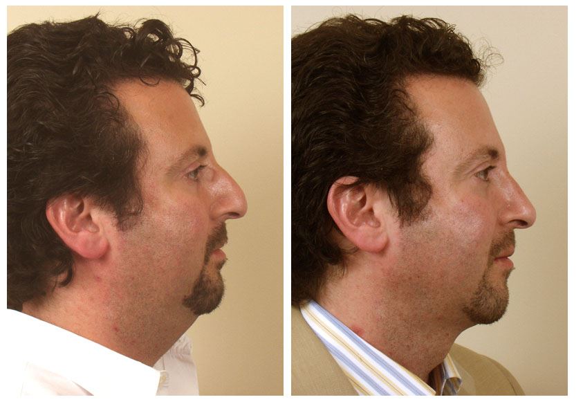 Achieve a Slim Neck with Neck Liposuction