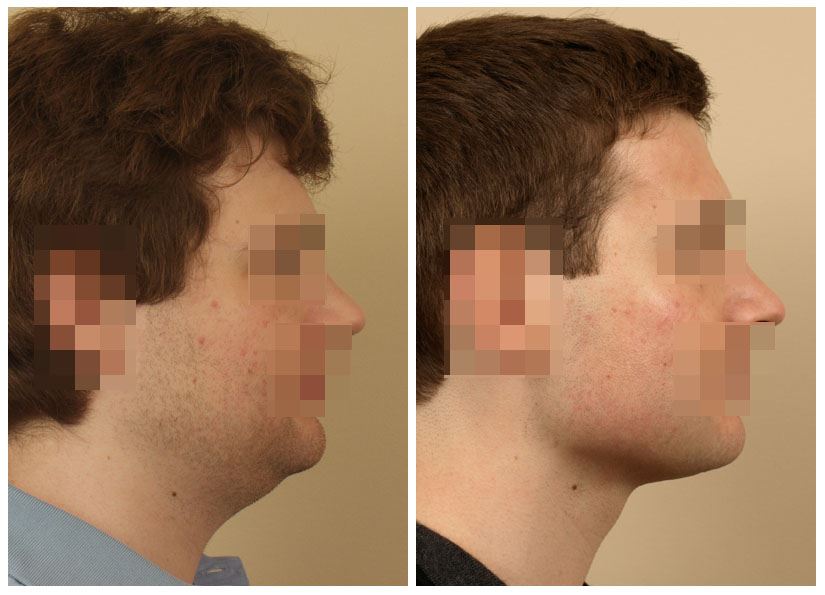 Neck Liposuction for a Contoured, Youthful Look