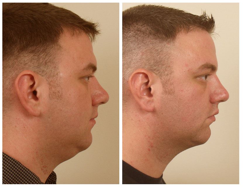 Sculpt Your Neckline with Neck Liposuction