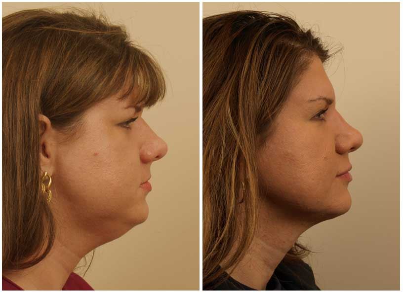 Neck Liposuction for a Sleek, Contoured Profile