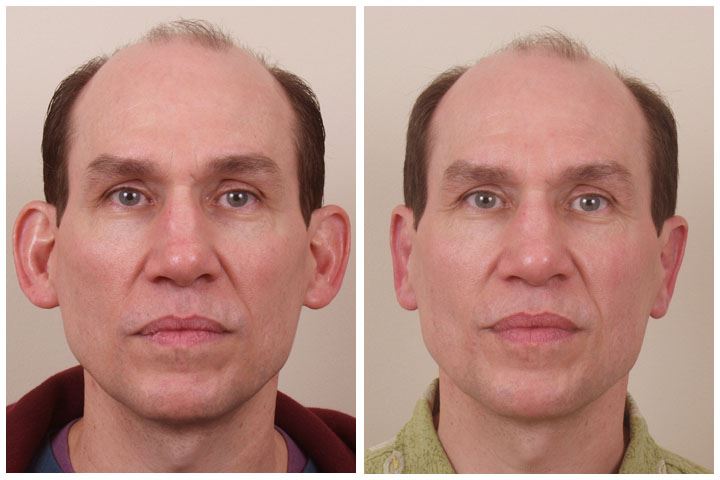Correct Protruding Ears with Otoplasty Surgery