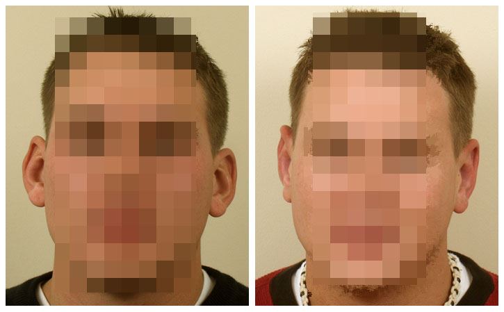 Otoplasty for Reshaping Ears and Boosting Confidence