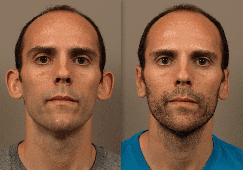 Otoplasty for Natural Ear Reshaping and Balance